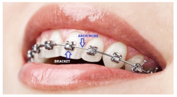 Fixed Braces